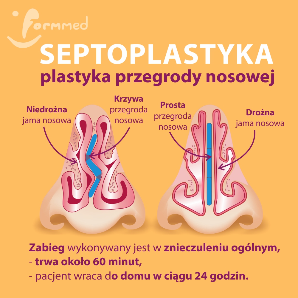 septoplastyka-plastyka-przegrody-nosa-Formmed-BabiceNowe-Warszawa